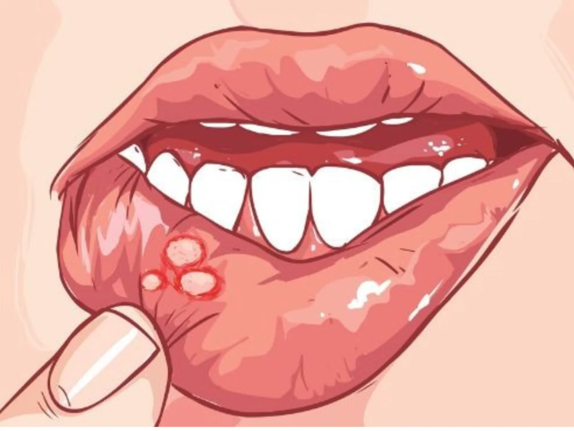 SFZ/LEKÁR RADÍ  - Afty bolia a otravujú život