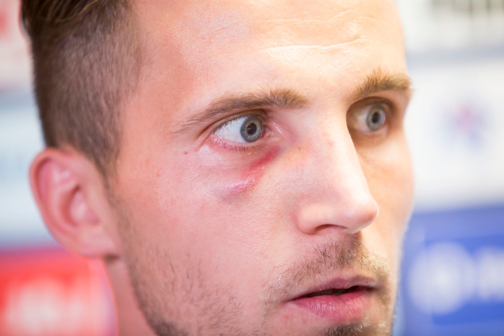 Peter Pekarík má po zápase s Anglickom monokel pod pravým okom.