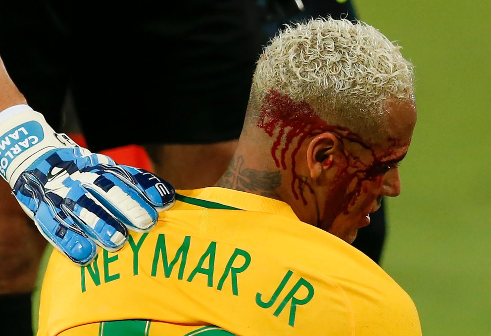 Hviezdny Neymar si okrem gólu a dvoch asistencií privodil aj tržnú ranu na hlave.